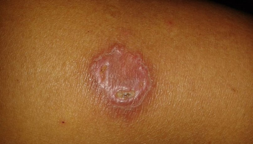 Detectan casos de leishmaniasis en Corrientes y advierten para evitar la propagación - Detectan casos de leishmaniasis en Corrientes y advierten para evitar la propagación
