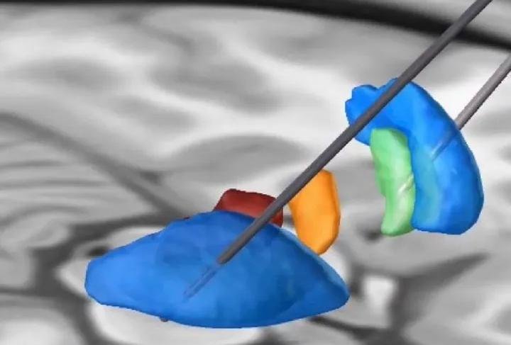 El Hospital Garrahan le realizó un implante cerebral a una niña con trastorno del movimiento severo 