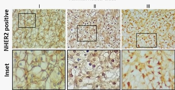Científicos de Corrientes hallaron una proteína que podría ayudar a tratar el cáncer renal